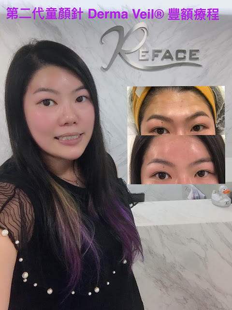 Nicole分享 第二代童颜针 Derma Veil® 丰额疗程 2 01