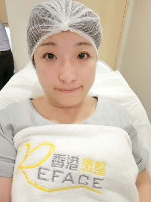 Carol分享 Cleviel埋線鼻尖拉提法 14 13