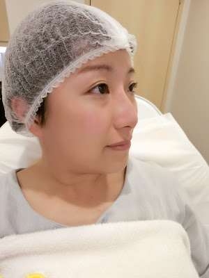 Carol分享 Cleviel埋線鼻尖拉提法 15 14