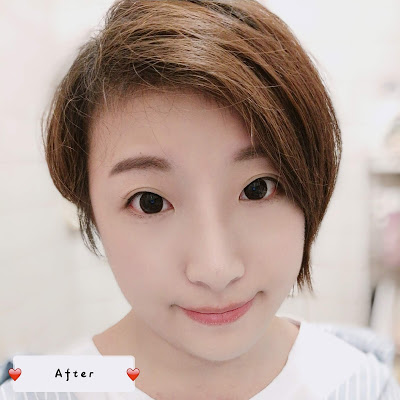 Carol分享 Cleviel埋線鼻尖拉提法 20 19