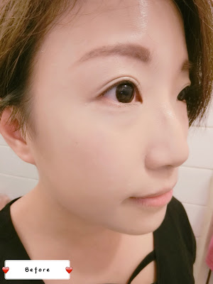 Carol分享 Cleviel埋線鼻尖拉提法 21 20