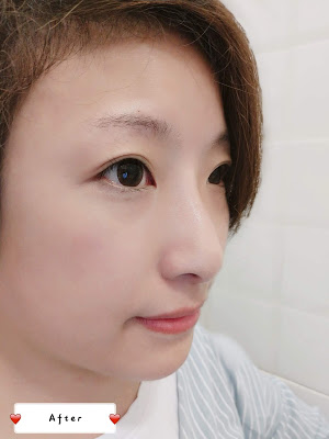 Carol分享 Cleviel埋線鼻尖拉提法 22 21