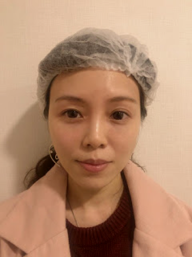 Ceci 分享 一枝TEOSYAL熊貓針~輕鬆消滅黑眼圈淚溝眼袋眼紋 6 Ceci Teosyal 5