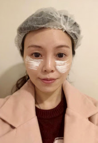 Ceci 分享 一枝TEOSYAL熊貓針~輕鬆消滅黑眼圈淚溝眼袋眼紋 7 Ceci Teosyal 6