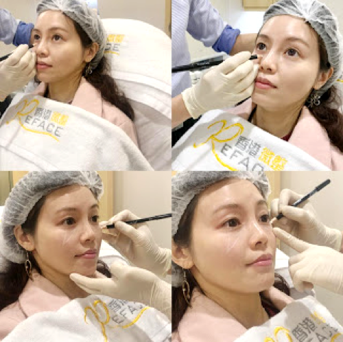 Ceci 分享 一枝TEOSYAL熊貓針~輕鬆消滅黑眼圈淚溝眼袋眼紋 8 Ceci Teosyal 7