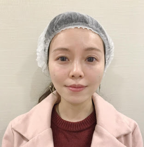 Ceci 分享 一枝TEOSYAL熊貓針~輕鬆消滅黑眼圈淚溝眼袋眼紋 10 Ceci Teosyal 9