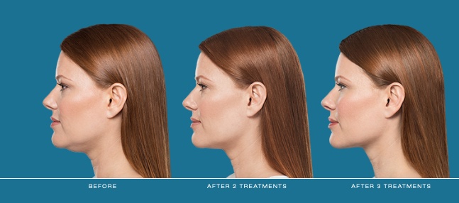 Belkyra溶脂針 img01