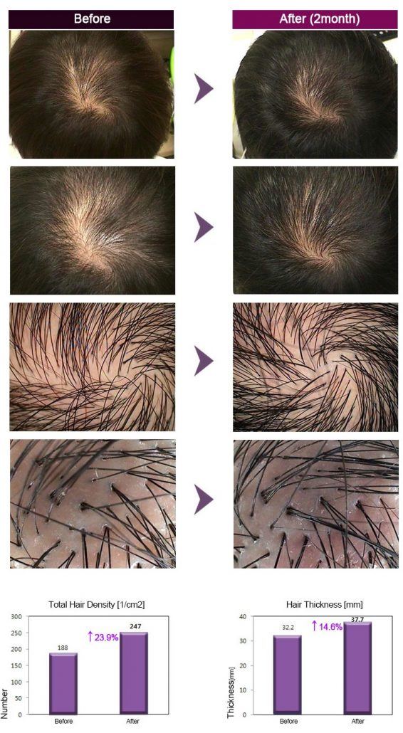 Dr CYJ養髮針 img02