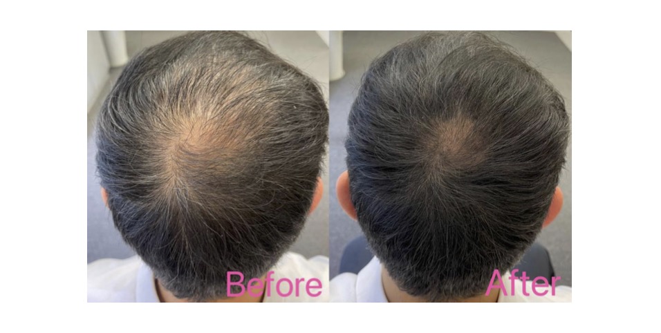 Sylfirm X 第二代矽谷电波 26 SYLFIRM X Before and After 15