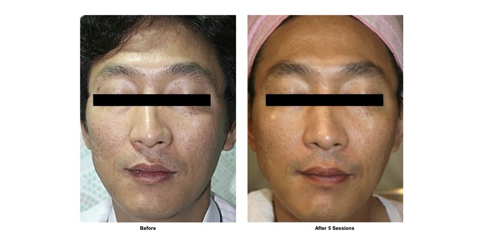 Sylfirm X 第二代矽谷电波 21 SYLFIRM X Before and After11