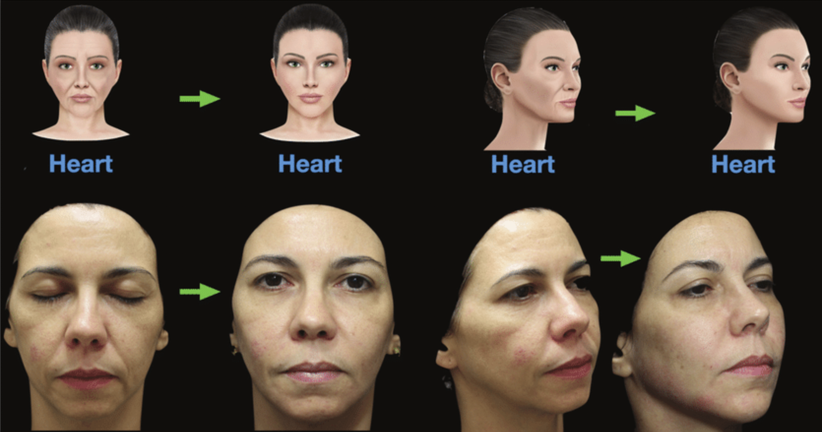 Haromonyca, 美神針